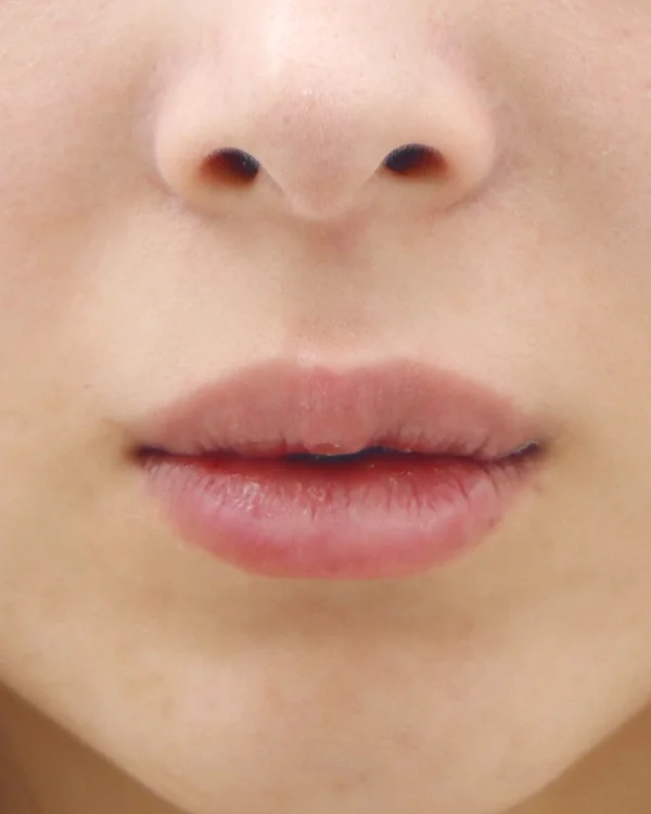 무흉 입술확대 (점막전진술) (점막전진술 재수술 (윗입술&아랫입술)) — 정면 수술 후, 수술 후 1주