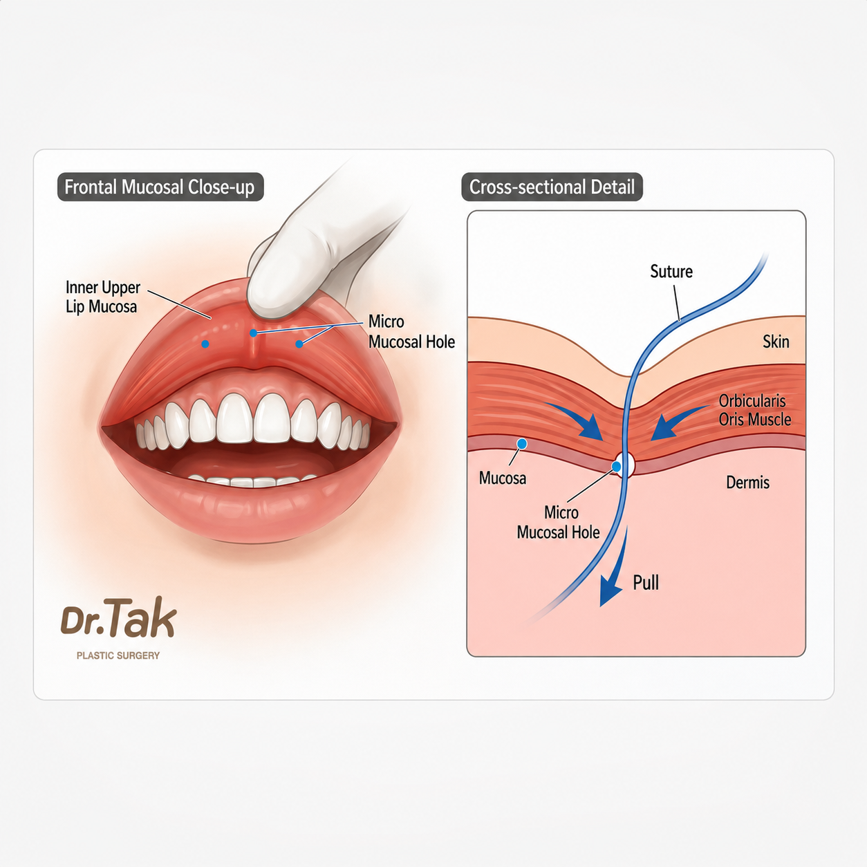 무흉 인중오목술