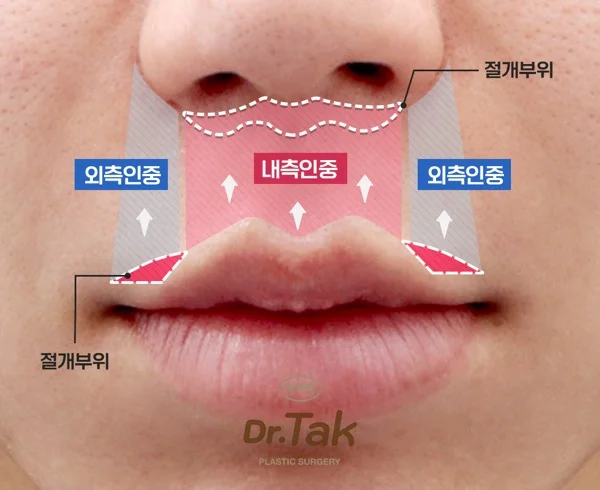 입술주변설명4.webp