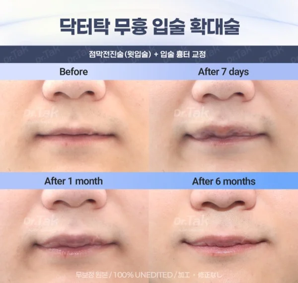 C-점막전진술전후사진1.webp