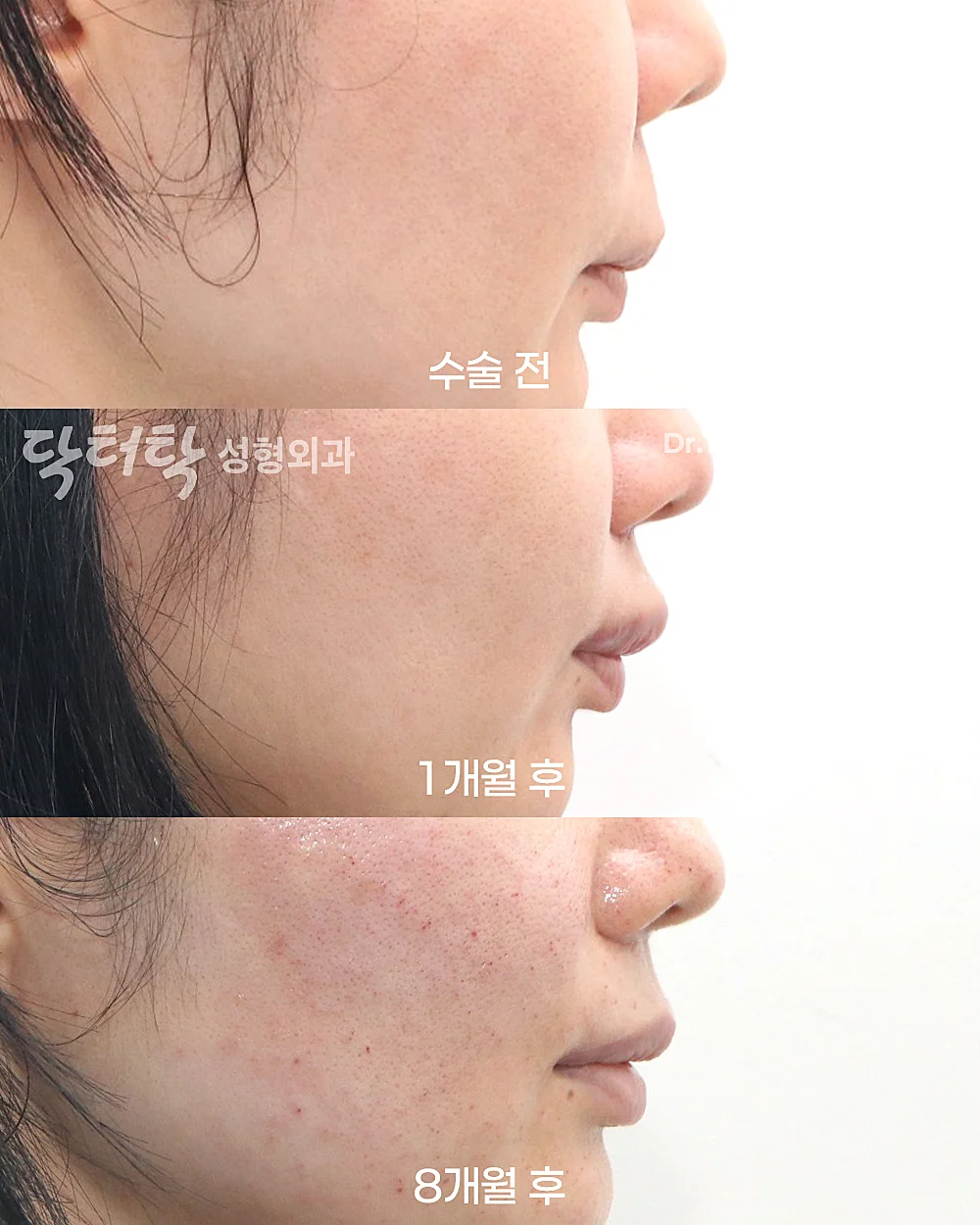 [แก้ไขใบหน้าส่วนกลาง_ก่อน-หลัง] ปรับรูปร่องริมฝีปาก (C-Curl) + ศัลยกรรมยกริมฝีปากบน (Lip Lift) + ยกริมฝีปากด้านข้าง (Lateral Lip Lift) + ยกมุมปาก (Corner Lip Lift) - แก้ไขริมฝีปาก, แก้ไขส่วนกลางใบหน้า (ร่องริมฝีปากบน) เคสก่อน-หลัง 3