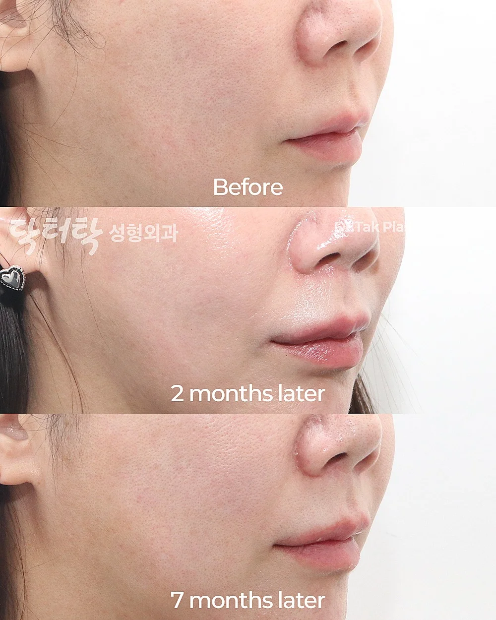 [ศัลยกรรมปรับรูปปาก] ศัลยกรรมยกริมฝีปากบน (Lip Lift) + ยกริมฝีปากด้านข้าง (Lateral Lip Lift) + ยกมุมปาก (Corner Lip Lift) - แก้ไขริมฝีปาก, แก้ไขส่วนกลางใบหน้า (ร่องริมฝีปากบน) เคสก่อน-หลัง 3