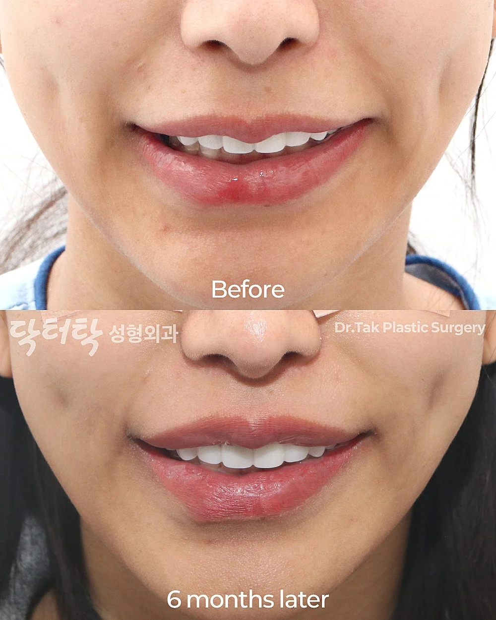 [ลดร่องริมฝีปากบน ก่อน-หลัง] ศัลยกรรมยกริมฝีปากบน (Lip Lift) - แก้ไขส่วนกลางใบหน้า (ร่องริมฝีปากบน) เคสก่อน-หลัง 3