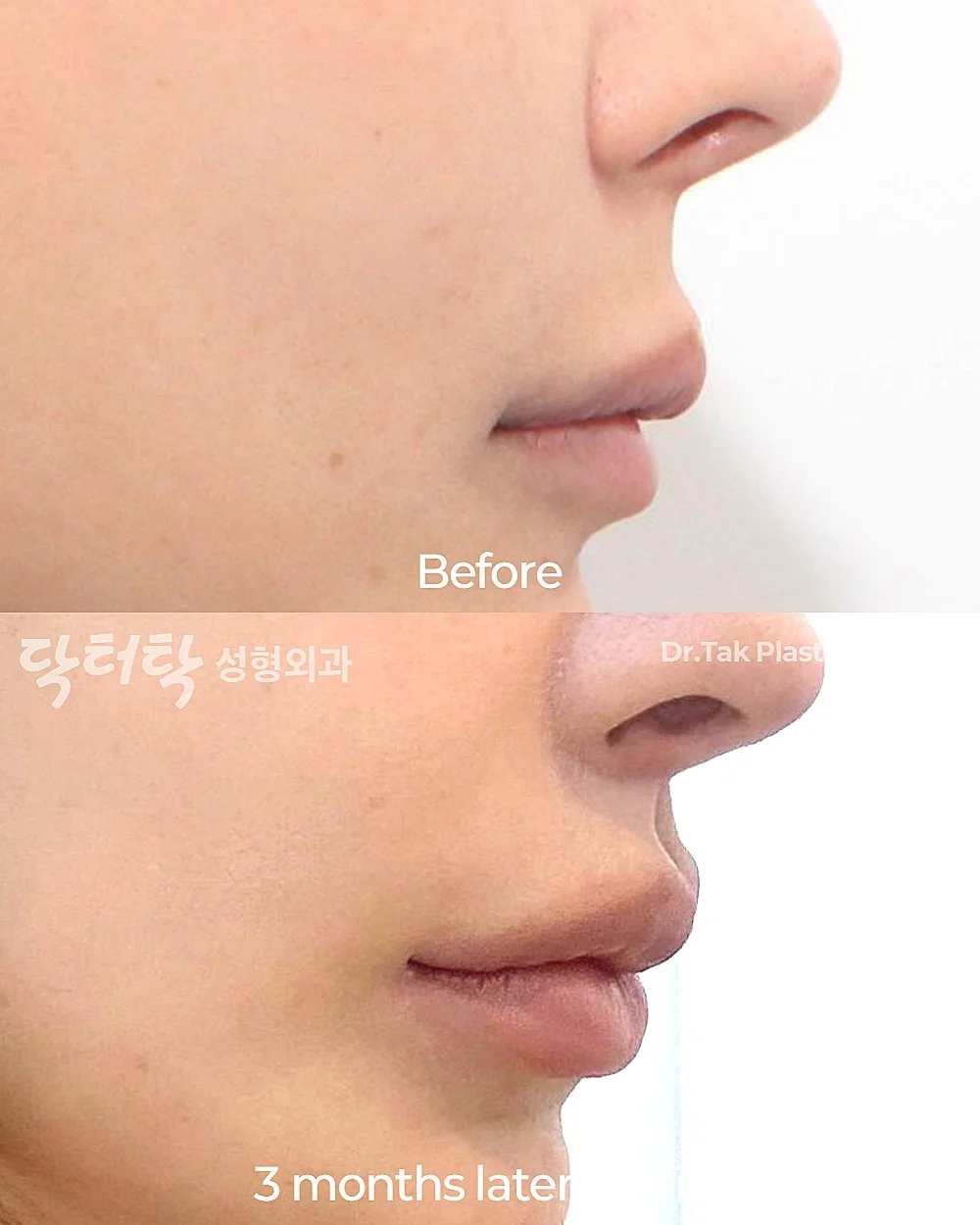 [ศัลยกรรมแก้ไขรูปปาก] ผ่าตัดปากกระจับ (ริมฝีปากบน) + ศัลยกรรมยกริมฝีปากบน (Lip Lift) + แก้ไขปรับรูปร่องริมฝีปาก (C-Curl) - แก้ไขริมฝีปาก, แก้ไขส่วนกลางใบหน้า (ร่องริมฝีปากบน) เคสก่อน-หลัง 3