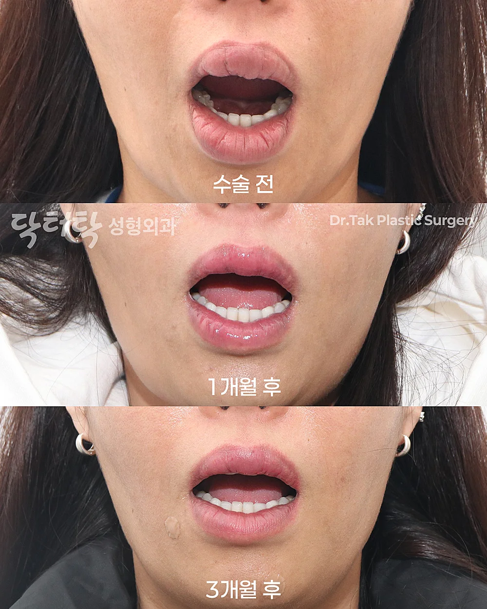 [ศัลยกรรมริมฝีปากไร้แผล_ก่อน-หลัง] ผ่าตัดนำสิ่งแปลกปลอมออกจากริมฝีปาก - แก้ไขริมฝีปาก, กำจัดฟิลเลอร์ริมฝีปาก เคสก่อน-หลัง 2