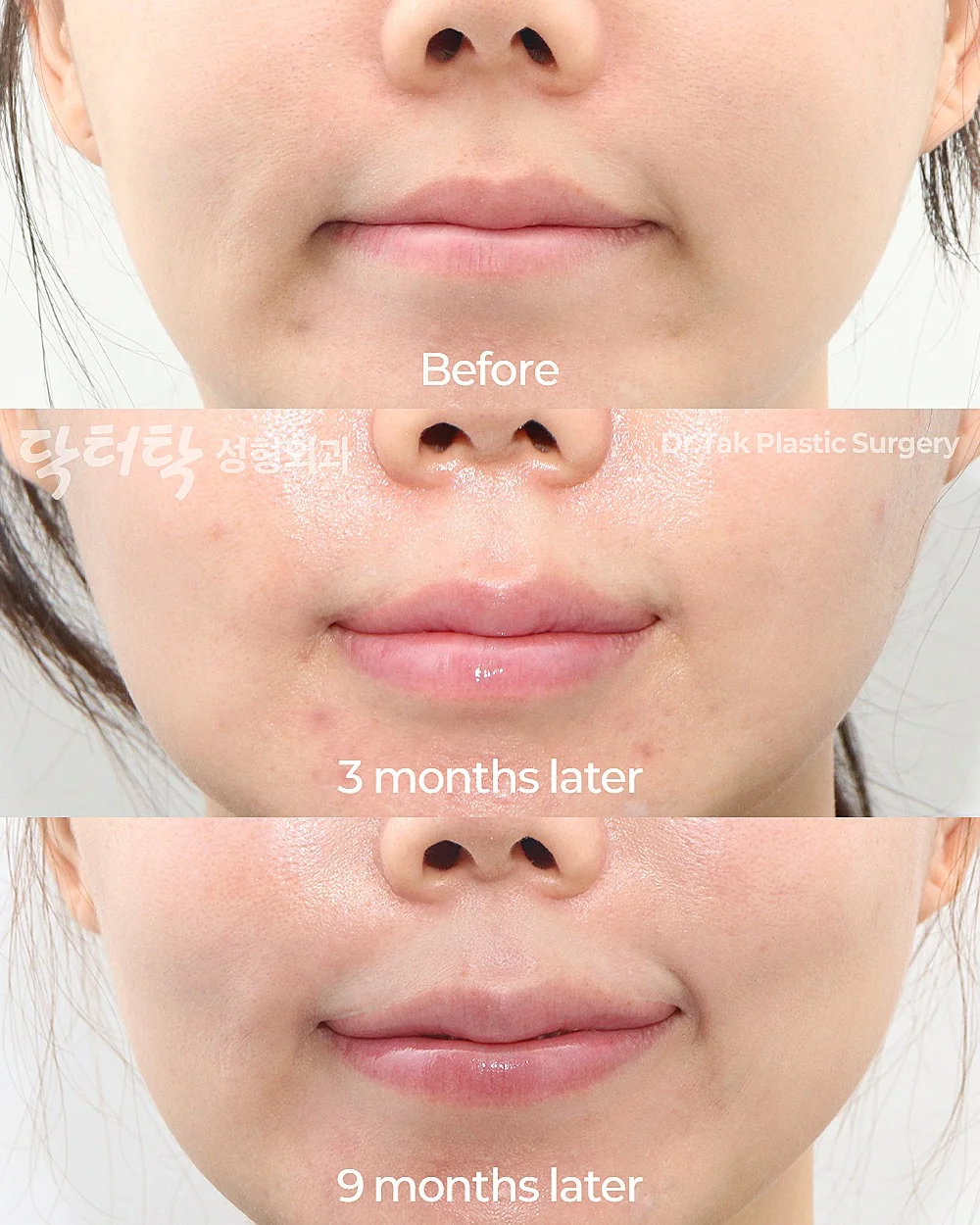 [แก้ไขปากคว่ำ] ยกริมฝีปากด้านข้าง (Lateral Lip Lift) + ยกมุมปาก (Corner Lip Lift) + ฟิลเลอร์ริมฝีปาก - แก้ไขริมฝีปาก, แก้ไขมุมปาก เคสก่อน-หลัง 3