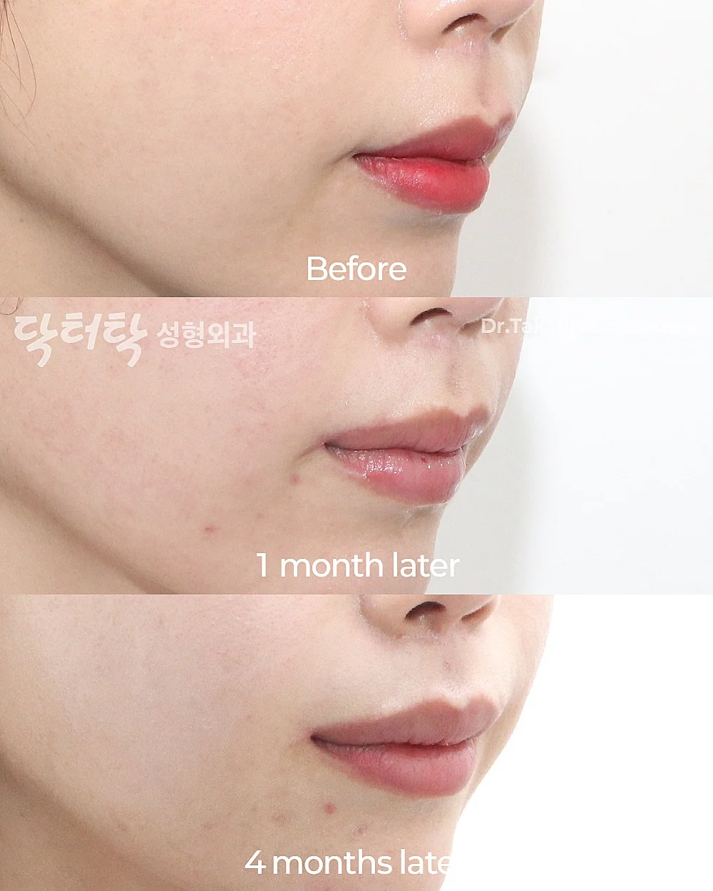 [ปรับรูปปาก_ก่อน-หลัง] ยกริมฝีปากด้านข้าง (Lateral Lip Lift) + ยกมุมปาก (Corner Lip Lift) - แก้ไขมุมปาก เคสก่อน-หลัง 3