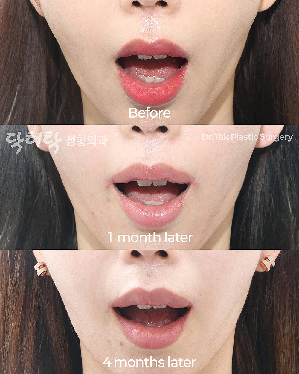 [ปรับรูปปาก_ก่อน-หลัง] ยกริมฝีปากด้านข้าง (Lateral Lip Lift) + ยกมุมปาก (Corner Lip Lift) - แก้ไขมุมปาก เคสก่อน-หลัง 2