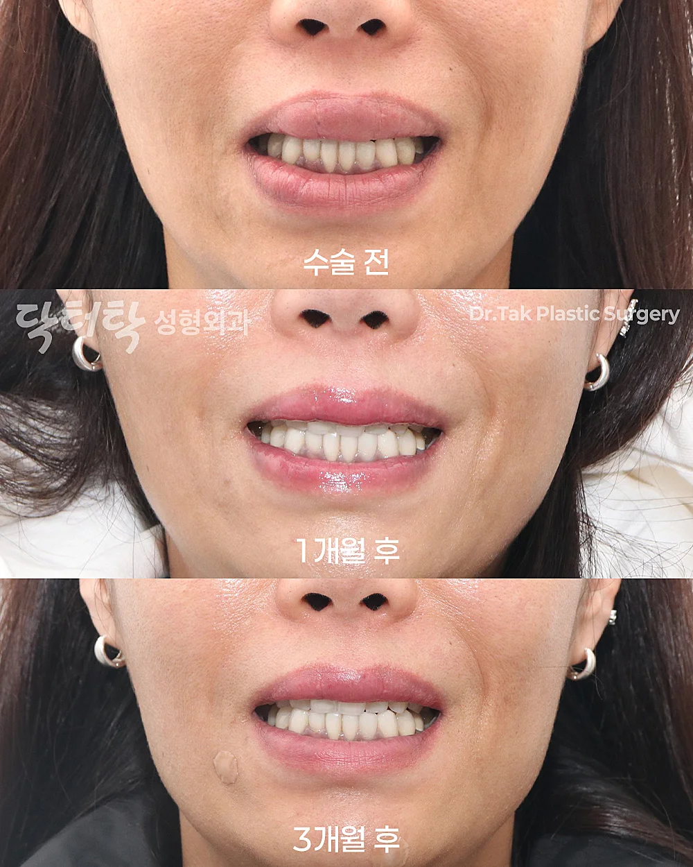[ศัลยกรรมริมฝีปากไร้แผล_ก่อน-หลัง] ผ่าตัดนำสิ่งแปลกปลอมออกจากริมฝีปาก - แก้ไขริมฝีปาก, กำจัดฟิลเลอร์ริมฝีปาก เคสก่อน-หลัง 3