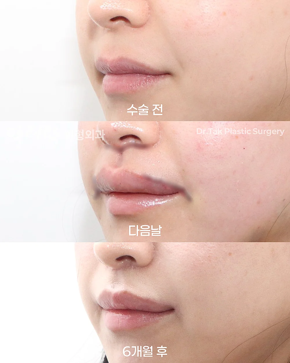 [ลดร่องริมฝีปากบน ก่อน-หลัง] ศัลยกรรมยกริมฝีปากบน (Lip Lift) + ยกริมฝีปากด้านข้าง (Lateral Lip Lift) + ยกมุมปาก (Corner Lip Lift) + ปรับรูปร่องริมฝีปากแบบผ่าตัด (C-Curl) - แก้ไขส่วนกลางใบหน้า (ร่องริมฝีปากบน), แก้ไขมุมปาก เคสก่อน-หลัง 2