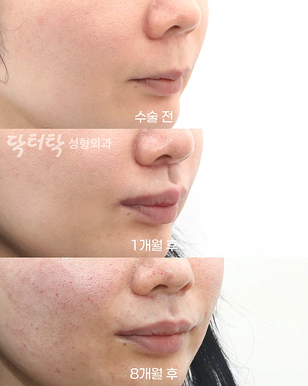 [แก้ไขใบหน้าส่วนกลาง_ก่อน-หลัง] ปรับรูปร่องริมฝีปาก (C-Curl) + ศัลยกรรมยกริมฝีปากบน (Lip Lift) + ยกริมฝีปากด้านข้าง (Lateral Lip Lift) + ยกมุมปาก (Corner Lip Lift) - แก้ไขริมฝีปาก, แก้ไขส่วนกลางใบหน้า (ร่องริมฝีปากบน) เคสก่อน-หลัง 2