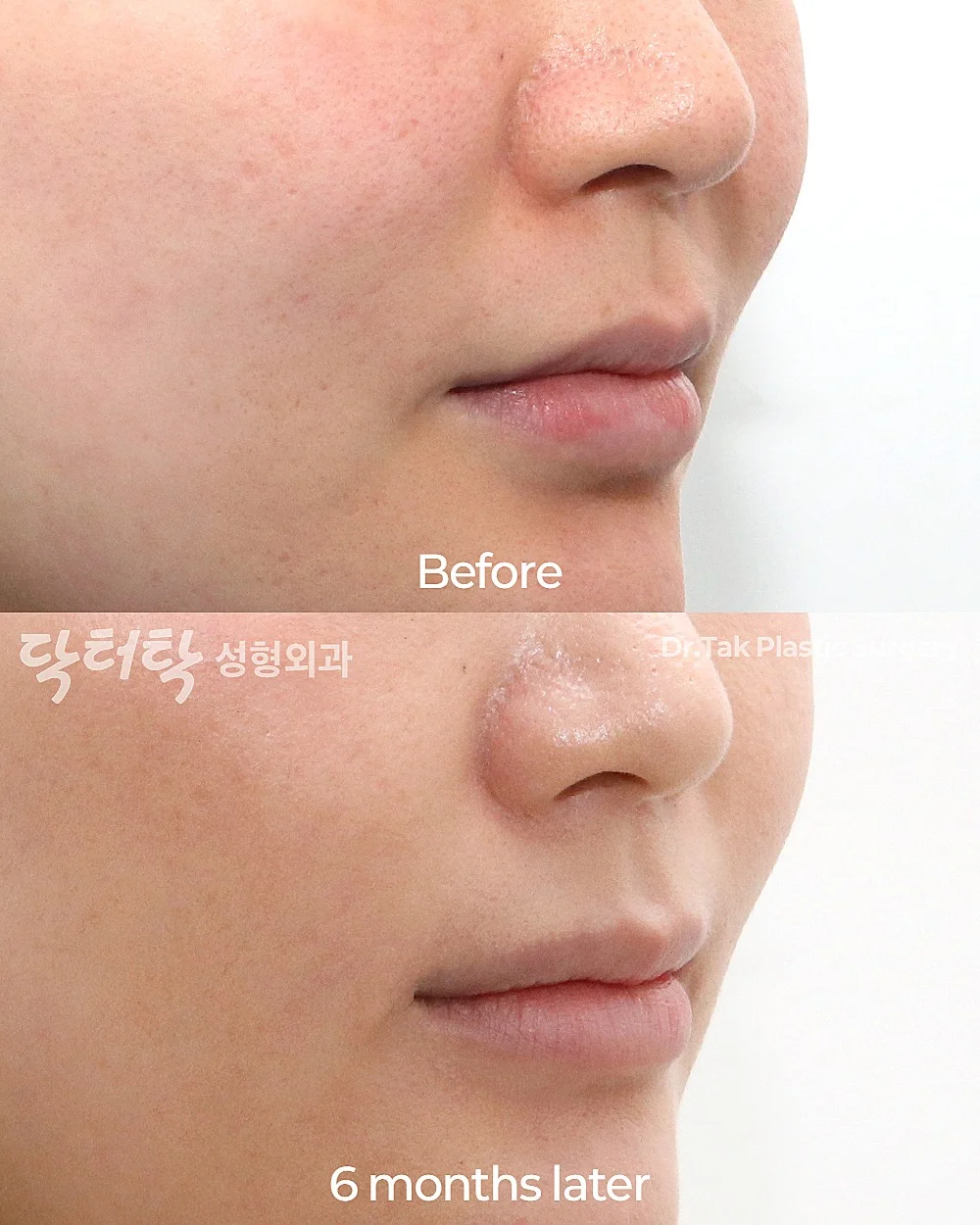 [แก้ไขมุมปาก_ก่อน-หลัง] ยกริมฝีปากด้านข้าง (Lateral Lip Lift) + ยกมุมปาก (Corner Lip Lift) - แก้ไขมุมปาก เคสก่อน-หลัง 2