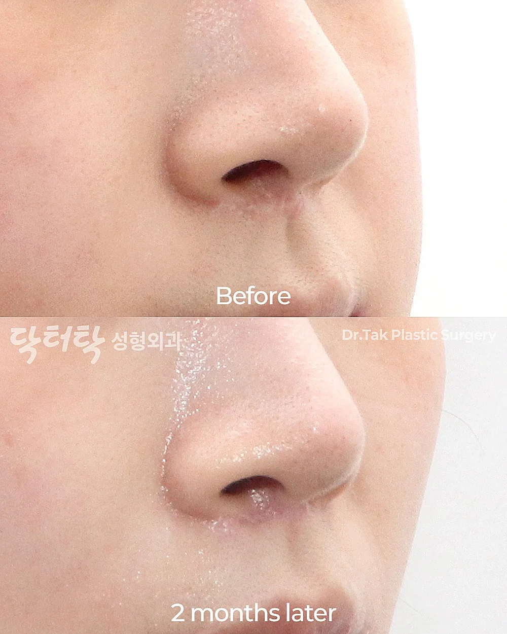 [แก้แผลเป็นจากการยกริมฝีปากบน_ก่อน-หลัง] แก้ไข Lip Lift - แก้ไขส่วนกลางใบหน้า (ร่องริมฝีปากบน), แก้ไขแผลเป็น เคสก่อน-หลัง 3