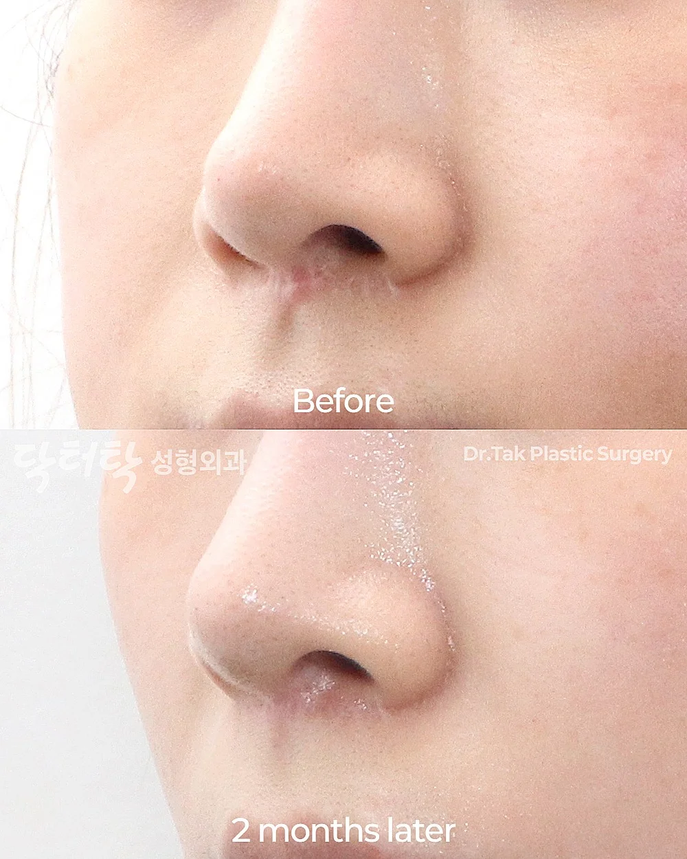 [แก้แผลเป็นจากการยกริมฝีปากบน_ก่อน-หลัง] แก้ไข Lip Lift - แก้ไขส่วนกลางใบหน้า (ร่องริมฝีปากบน), แก้ไขแผลเป็น เคสก่อน-หลัง 2