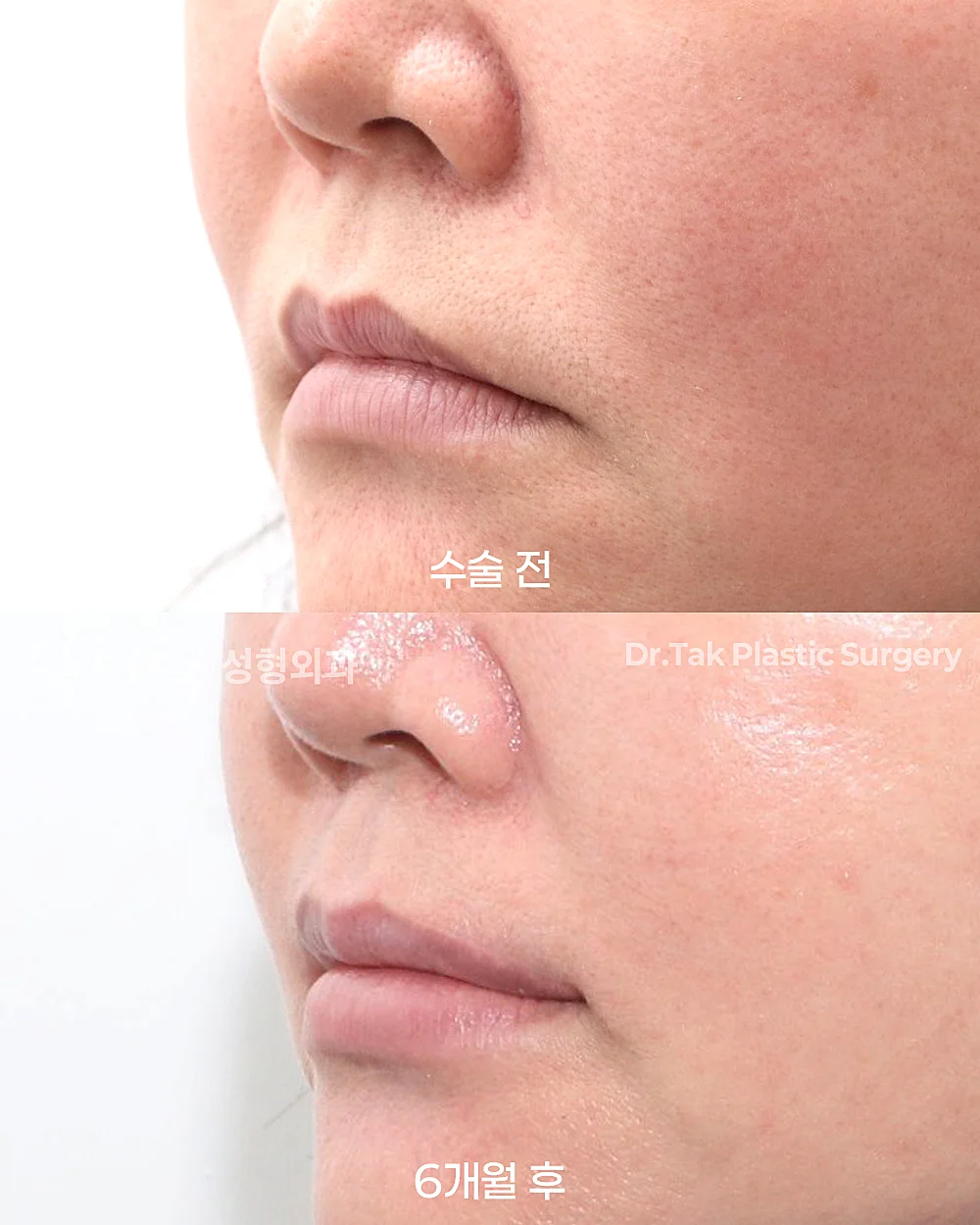 [ปรับใบหน้าส่วนกลางวัยกลางคน] ยกริมฝีปากด้านข้าง (Lateral Lip Lift) + ยกมุมปาก (Corner Lip Lift) - แก้ไขมุมปาก เคสก่อน-หลัง 2