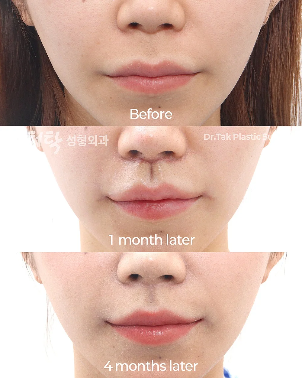 [ศัลยกรรมลดความยาวใบหน้าส่วนกลาง_ก่อน-หลัง] ศัลยกรรมยกริมฝีปากบน (Lip Lift) + ปรับรูปร่องริมฝีปาก (C-Curl) + ลดขนาดริมฝีปาก (ริมฝีปากบน) + ยกริมฝีปากด้านข้าง (Lateral Lip Lift) + ยกมุมปาก (Corner Lip Lift) - แก้ไขริมฝีปาก, แก้ไขส่วนกลางใบหน้า (ร่องริมฝีปากบน) เคสก่อน-หลัง 2