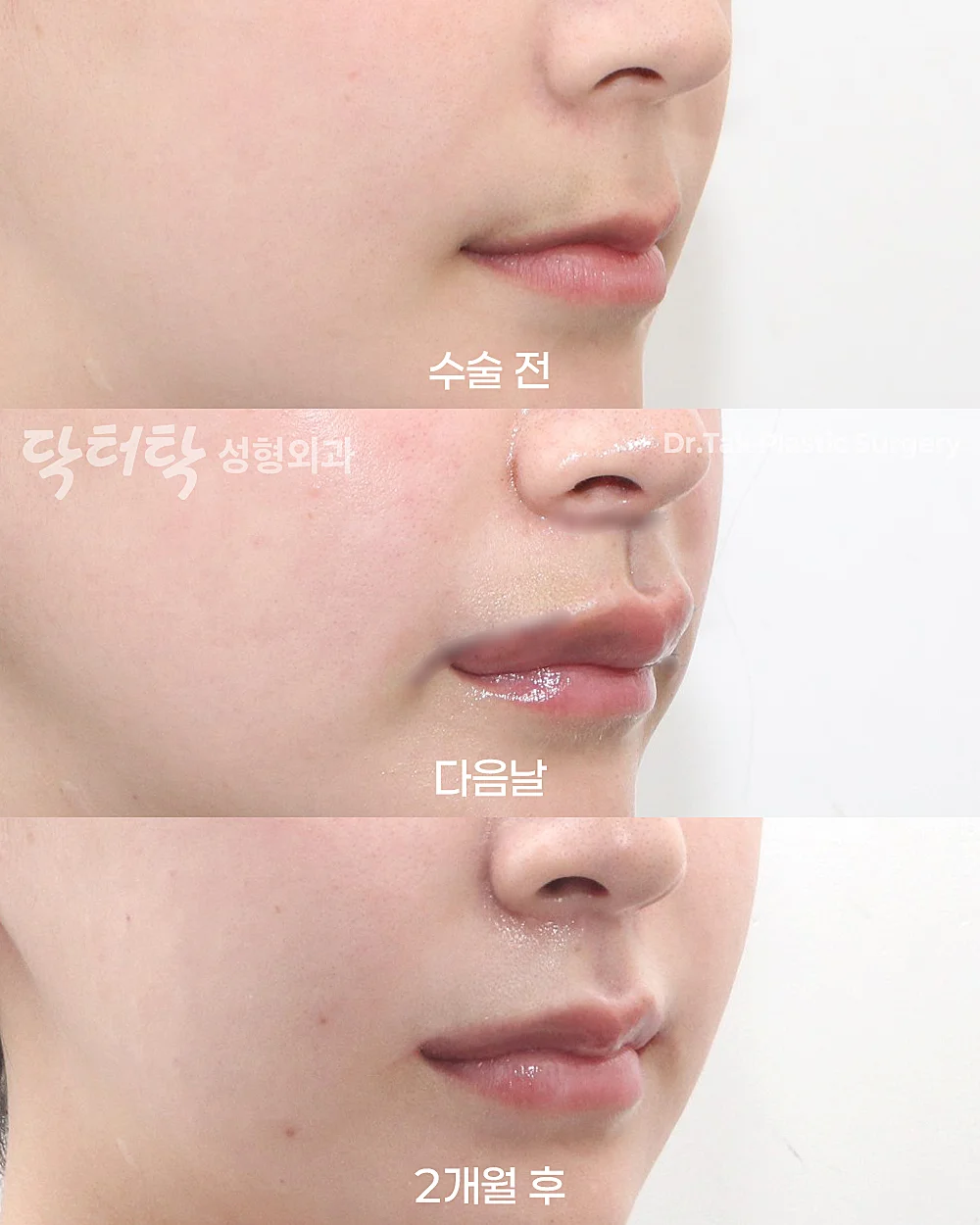 [ปรับรูปร่องริมฝีปากแบบผ่าตัด] ปรับรูปร่องริมฝีปาก (C-Curl) + ศัลยกรรมยกริมฝีปากบน (Lip Lift) + ยกริมฝีปากด้านข้าง (Lateral Lip Lift) + ยกมุมปาก (Corner Lip Lift) - แก้ไขริมฝีปาก, แก้ไขส่วนกลางใบหน้า (ร่องริมฝีปากบน) เคสก่อน-หลัง 2