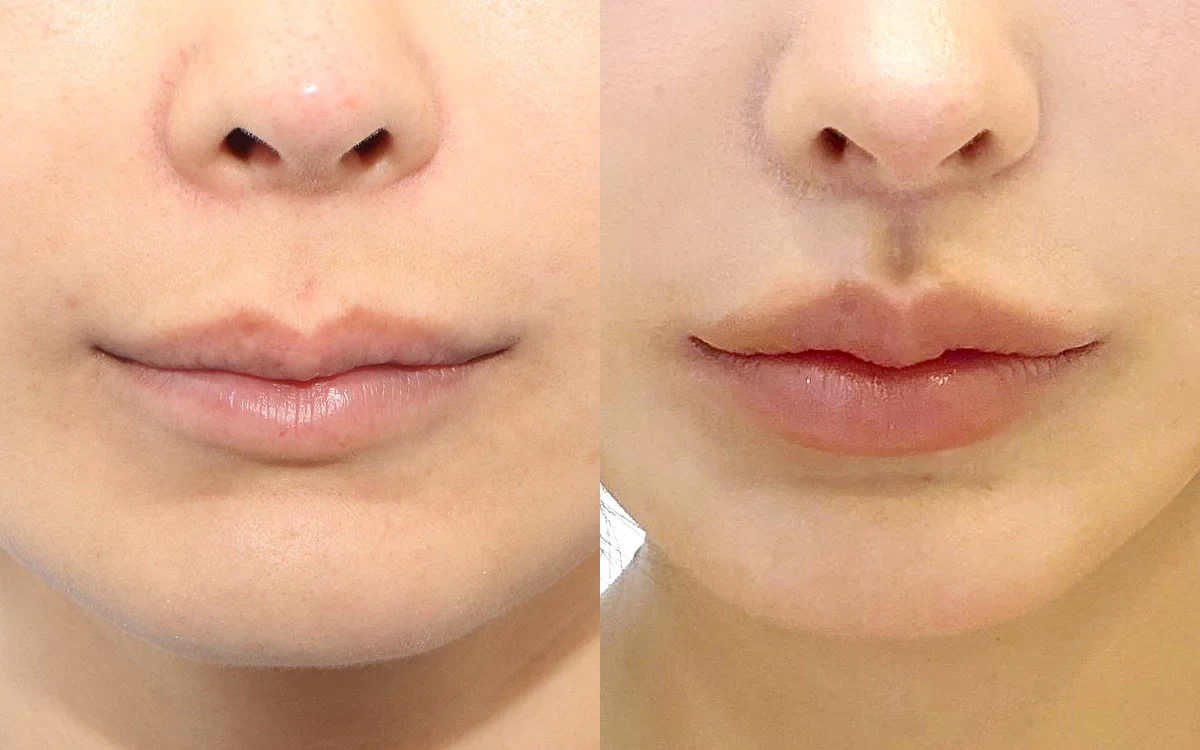 Cắt môi trái tim Hàn Quốc (Cắt môi trái tim (Môi trên) + Thu ngắn nhân trung (Lip Lift) + Tạo rãnh nhân trung (C-Curl) Chỉnh sửa) — Chính diện Trước · Sau, 3 tháng sau phẫu thuật