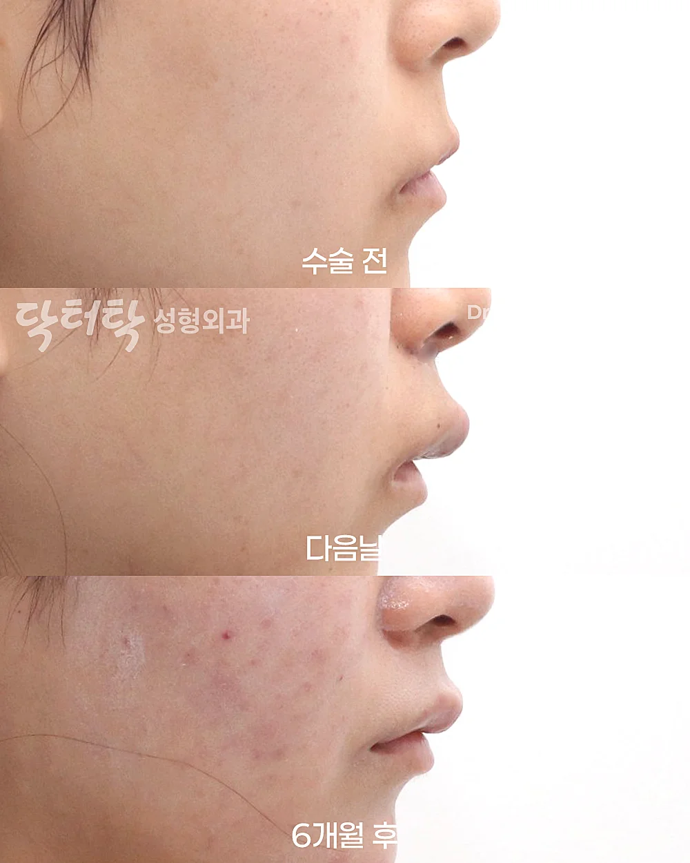[ปรับรูปร่องริมฝีปากแบบผ่าตัด] ปรับรูปร่องริมฝีปาก (C-Curl) + ศัลยกรรมยกริมฝีปากบน (Lip Lift) - แก้ไขส่วนกลางใบหน้า (ร่องริมฝีปากบน), สร้างร่องริมฝีปากบน (C-curl) เคสก่อน-หลัง 2
