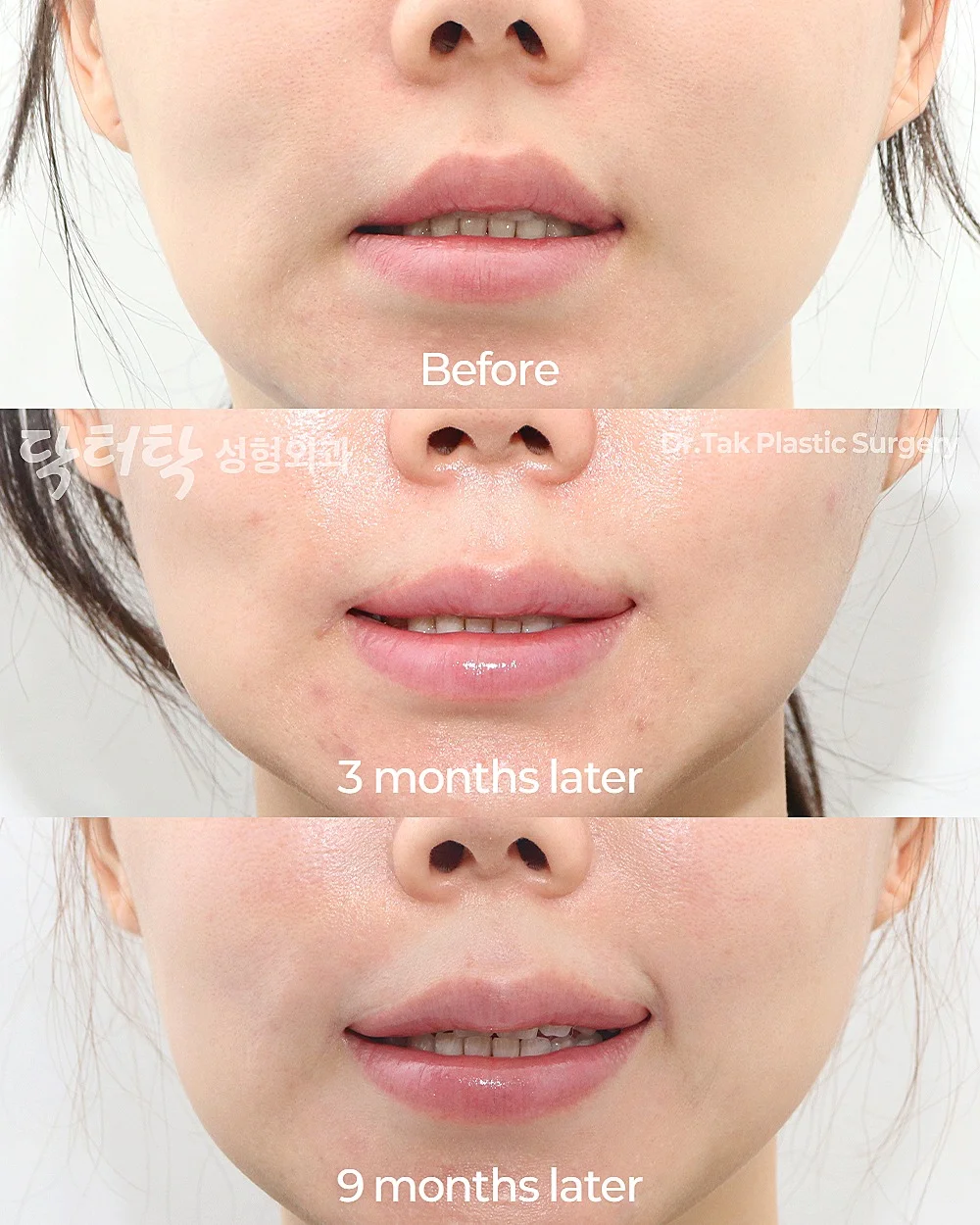 [แก้ไขปากคว่ำ] ยกริมฝีปากด้านข้าง (Lateral Lip Lift) + ยกมุมปาก (Corner Lip Lift) + ฟิลเลอร์ริมฝีปาก - แก้ไขริมฝีปาก, แก้ไขมุมปาก เคสก่อน-หลัง 2