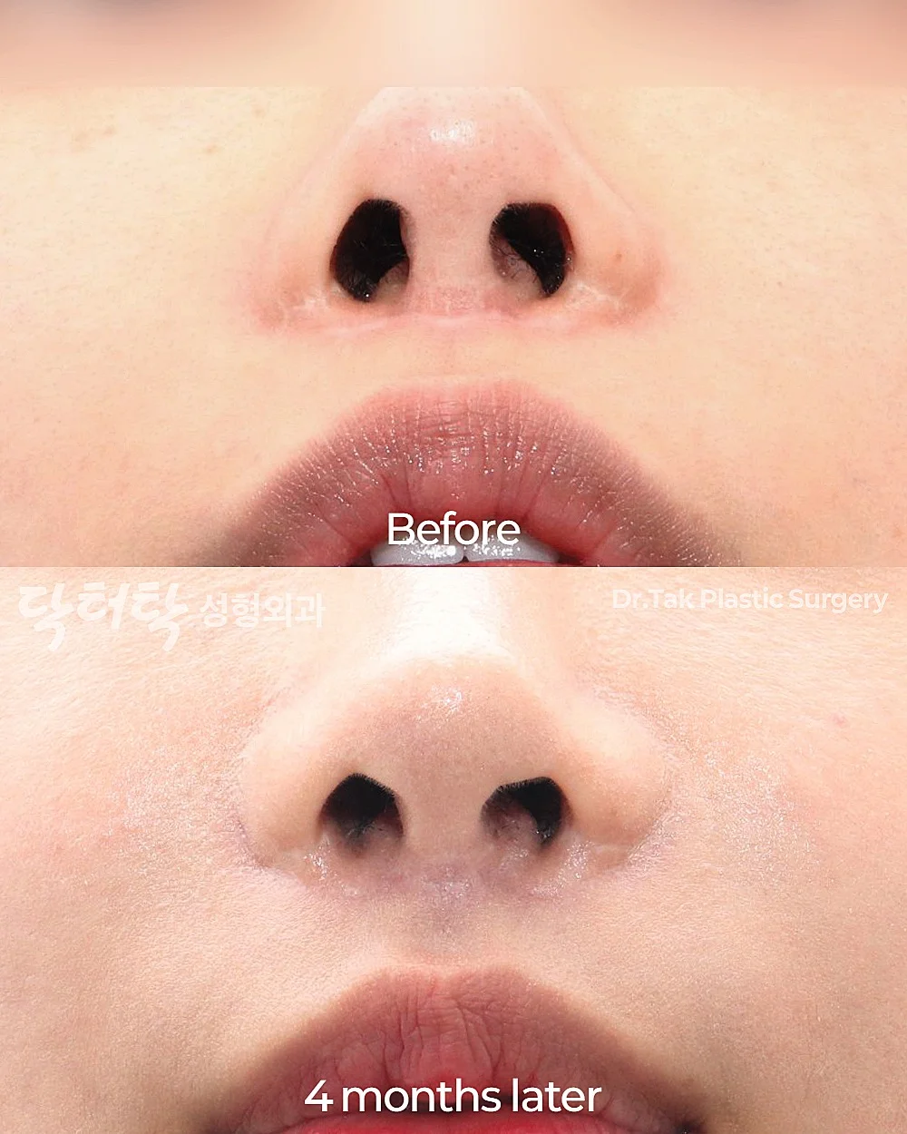 [แก้แผลเป็นจากการยกริมฝีปากบน_ก่อน-หลัง] แก้ไข Lip Lift - แก้ไขส่วนกลางใบหน้า (ร่องริมฝีปากบน), แก้ไขแผลเป็น เคสก่อน-หลัง 2