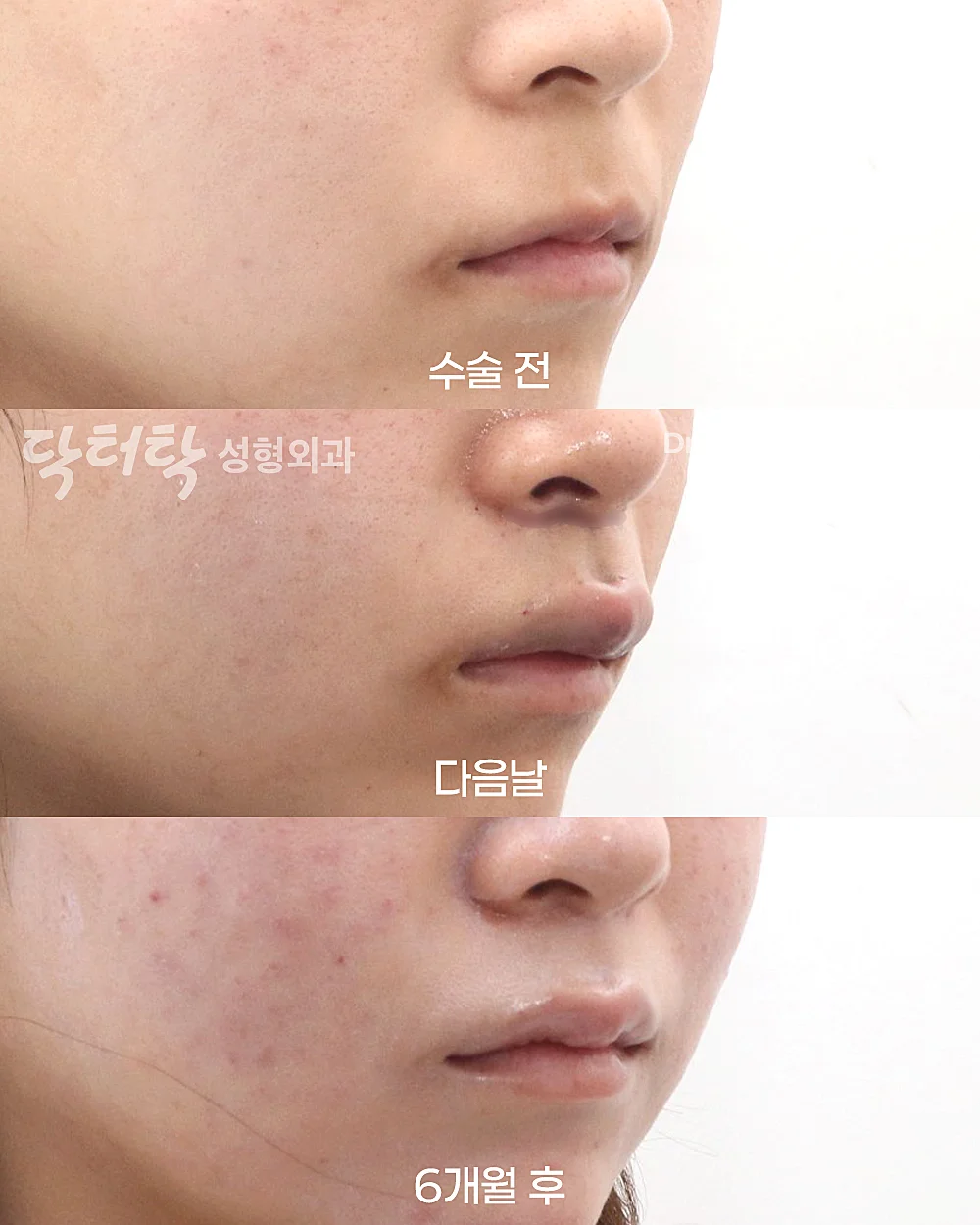 [ปรับรูปร่องริมฝีปากแบบผ่าตัด] ปรับรูปร่องริมฝีปาก (C-Curl) + ศัลยกรรมยกริมฝีปากบน (Lip Lift) - แก้ไขส่วนกลางใบหน้า (ร่องริมฝีปากบน), สร้างร่องริมฝีปากบน (C-curl) เคสก่อน-หลัง 3