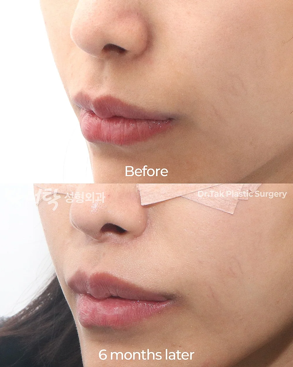 [ลดร่องริมฝีปากบน ก่อน-หลัง] ศัลยกรรมยกริมฝีปากบน (Lip Lift) - แก้ไขส่วนกลางใบหน้า (ร่องริมฝีปากบน) เคสก่อน-หลัง 4