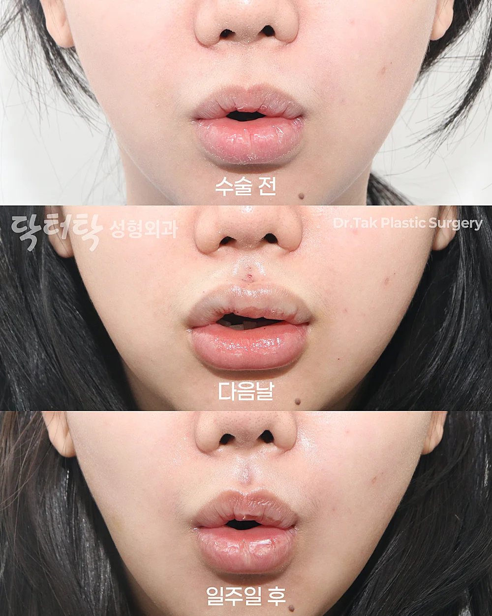 [ทำร่องริมฝีปากบนแบบไม่ต้องผ่า_ก่อน-หลัง] ปรับรูปร่องริมฝีปากแบบไม่ผ่าตัด (C-Curl) - สร้างร่องริมฝีปากบน (C-curl) เคสก่อน-หลัง 2