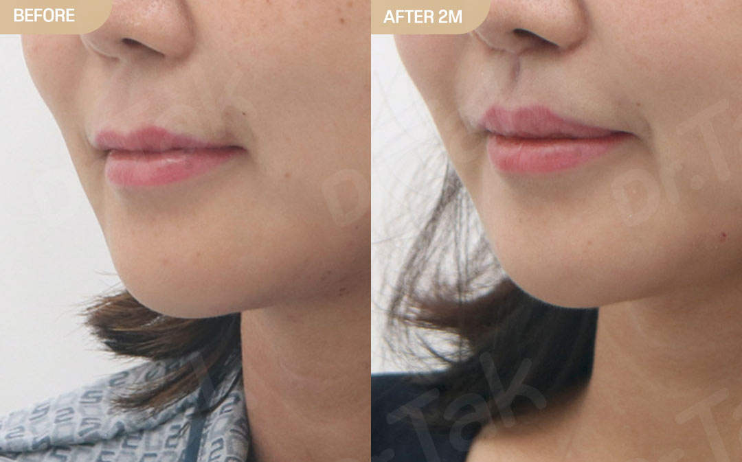 [ศัลยกรรมส่วนกลางใบหน้า_ก่อน-หลัง] ลดร่องด้านใน + สร้างร่องริมฝีปากบน + ฟิลเลอร์ริมฝีปาก + ฟิลเลอร์สันริมฝีปาก - แก้ไขส่วนกลางใบหน้า (ร่องริมฝีปากบน) เคสก่อน-หลัง 2