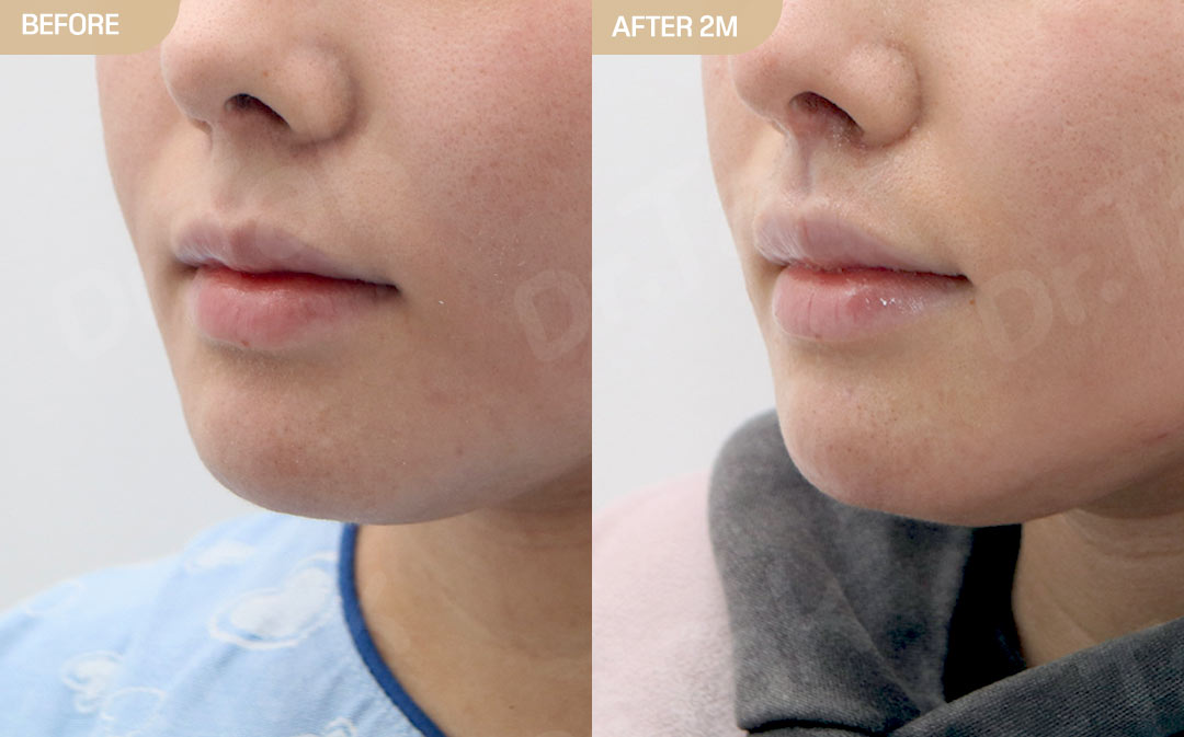 [ศัลยกรรมลดส่วนกลางใบหน้า_ก่อน-หลัง] ลดร่องริมฝีปากบน (ด้านใน) + สร้างร่องริมฝีปากบน (ศัลยกรรมเพิ่มความชัดร่องริมฝีปากบน) + ฟิลเลอร์ร่องริมฝีปากบน - แก้ไขส่วนกลางใบหน้า (ร่องริมฝีปากบน) เคสก่อน-หลัง 2