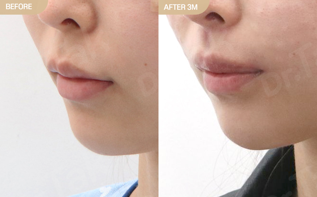 [ลดส่วนกลางใบหน้า_ก่อน-หลัง] ลดร่องด้านนอก + กรีดมุมปาก + ลดร่องด้านใน + สร้างร่องริมฝีปากบน + โบท็อกซ์ลดร่องริมฝีปากบน + สลายฟิลเลอร์ - แก้ไขส่วนกลางใบหน้า (ร่องริมฝีปากบน) เคสก่อน-หลัง 2
