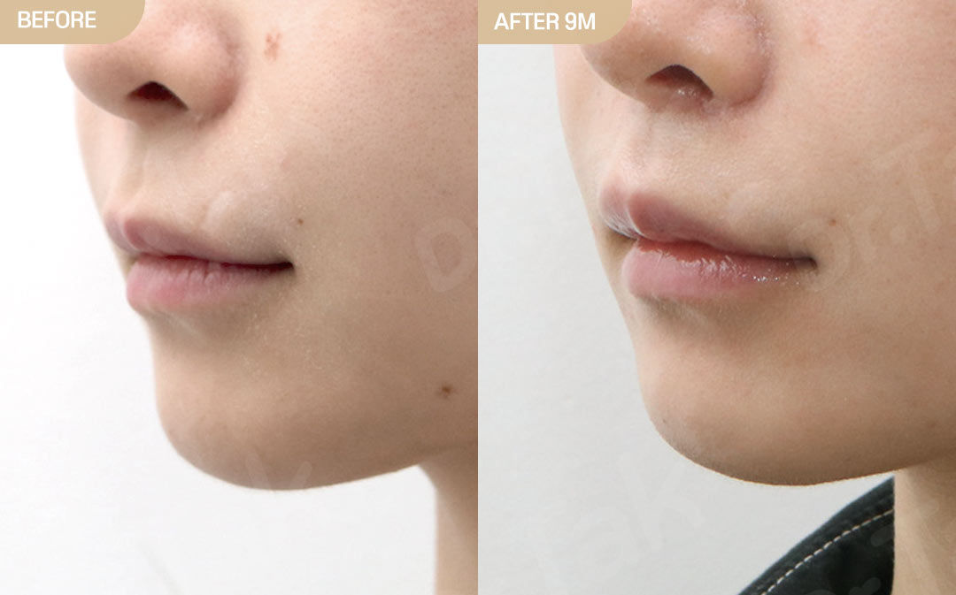[แก้ไขริมฝีปาก, ลดร่องริมฝีปากบน_ก่อน-หลัง] Cupid's bow (ริมฝีปากบน) + ลดร่องด้านใน (ผ่าตัดแก้ไข) + โบท็อกซ์ลดร่องริมฝีปากบน - แก้ไขส่วนกลางใบหน้า (ร่องริมฝีปากบน) เคสก่อน-หลัง 2