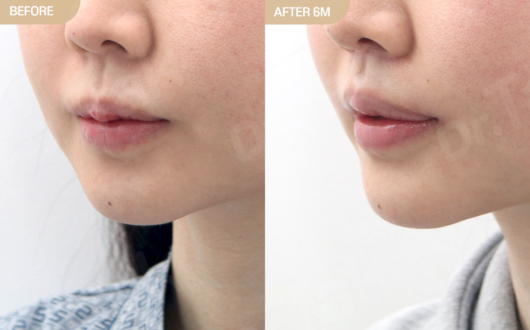 [ศัลยกรรมริมฝีปาก_ก่อน-หลัง] ลดร่องด้านนอก + ศัลยกรรมมุมปาก + ลดร่องด้านใน + สร้างร่องริมฝีปากบน - แก้ไขริมฝีปาก เคสก่อน-หลัง 2
