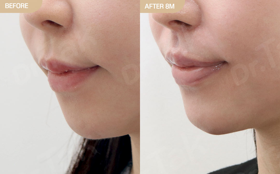 [ศัลยกรรมมุมปาก_ก่อน-หลัง] ลดร่องด้านนอก + ยกมุมปาก + ลดร่องด้านใน + สร้างร่องริมฝีปากบน + สลายฟิลเลอร์ - แก้ไขมุมปาก เคสก่อน-หลัง 2