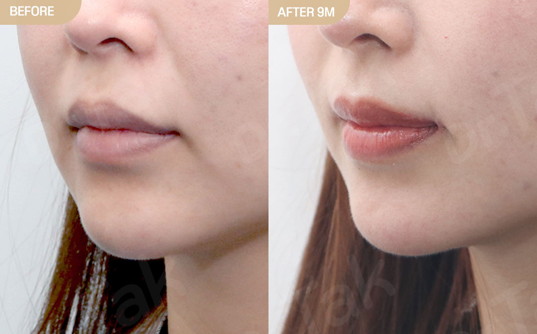 [แก้ไขริมฝีปากม้วนเข้า_ก่อน-หลัง] ลดร่องด้านนอก + แก้ไขมุมปาก + สลายฟิลเลอร์ริมฝีปาก - แก้ไขริมฝีปาก เคสก่อน-หลัง 2