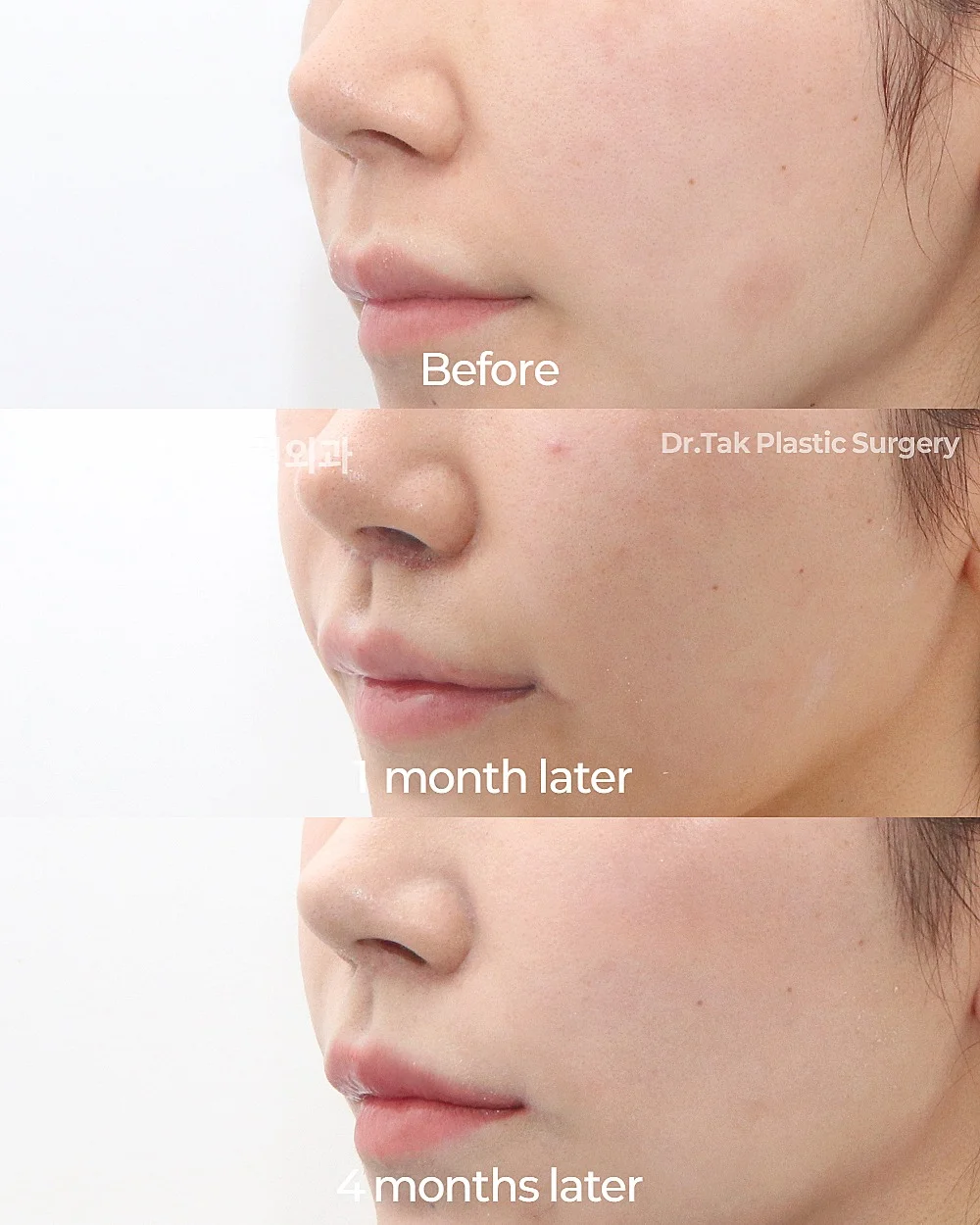 [ศัลยกรรมลดความยาวใบหน้าส่วนกลาง_ก่อน-หลัง] ศัลยกรรมยกริมฝีปากบน (Lip Lift) + ปรับรูปร่องริมฝีปาก (C-Curl) + ลดขนาดริมฝีปาก (ริมฝีปากบน) + ยกริมฝีปากด้านข้าง (Lateral Lip Lift) + ยกมุมปาก (Corner Lip Lift) - แก้ไขริมฝีปาก, แก้ไขส่วนกลางใบหน้า (ร่องริมฝีปากบน) เคสก่อน-หลัง 3