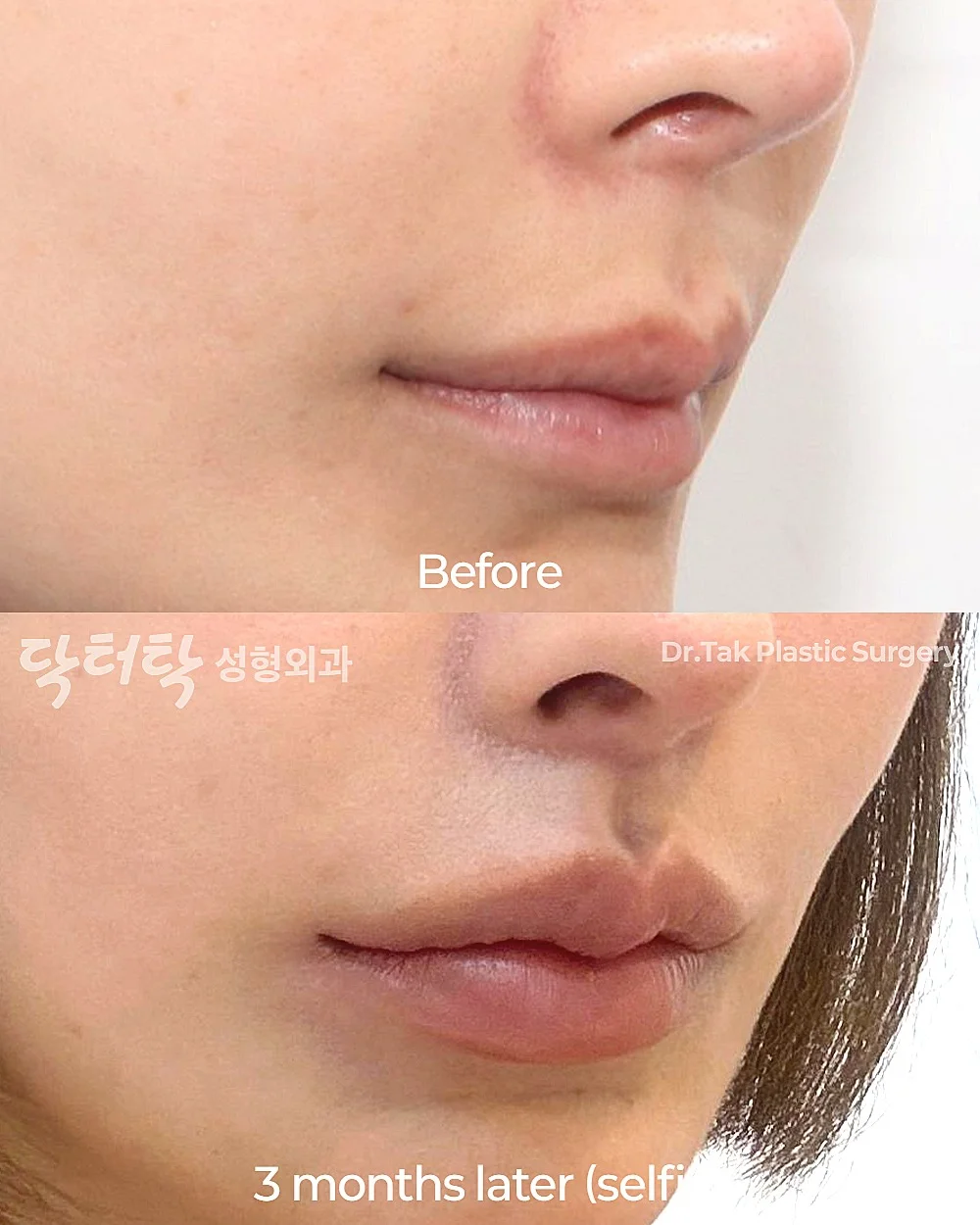 [ศัลยกรรมแก้ไขรูปปาก] ผ่าตัดปากกระจับ (ริมฝีปากบน) + ศัลยกรรมยกริมฝีปากบน (Lip Lift) + แก้ไขปรับรูปร่องริมฝีปาก (C-Curl) - แก้ไขริมฝีปาก, แก้ไขส่วนกลางใบหน้า (ร่องริมฝีปากบน) เคสก่อน-หลัง 2