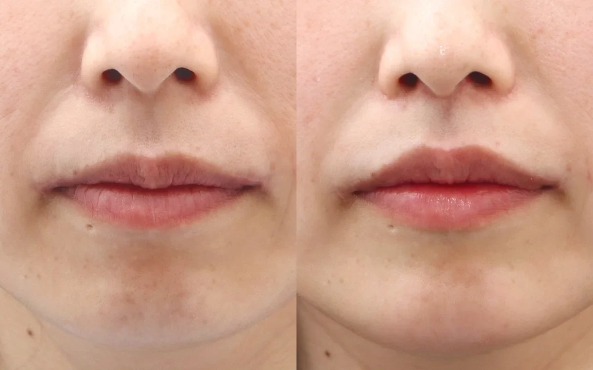 Thu ngắn nhân trung (Lip Lift) (Thu ngắn nhân trung (Lip Lift) + Tạo rãnh nhân trung (C-Curl)) — Chính diện Trước · Sau, 6 tháng sau phẫu thuật