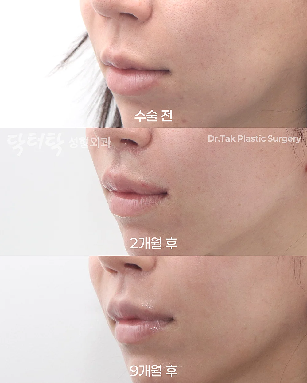 [แก้ไขใบหน้าส่วนกลาง_ก่อน-หลัง] ศัลยกรรมยกริมฝีปากบน (Lip Lift) + ยกริมฝีปากด้านข้าง (Lateral Lip Lift) + ยกมุมปาก (Corner Lip Lift) + สลายฟิลเลอร์ริมฝีปากล่าง - แก้ไขริมฝีปาก, แก้ไขส่วนกลางใบหน้า (ร่องริมฝีปากบน) เคสก่อน-หลัง 3