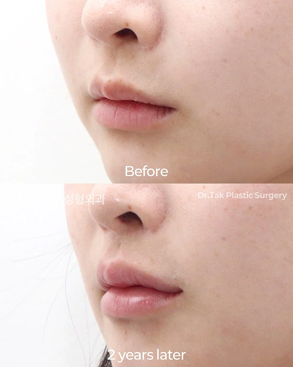 [ศัลยกรรมขยายปากให้กว้างขึ้น] ยืดมุมปาก + ยกมุมปาก (Corner Lip Lift) + ยกริมฝีปากด้านข้าง (Lateral Lip Lift) + ศัลยกรรมยกริมฝีปากบน (Lip Lift) - แก้ไขริมฝีปาก, แก้ไขส่วนกลางใบหน้า (ร่องริมฝีปากบน) เคสก่อน-หลัง 2