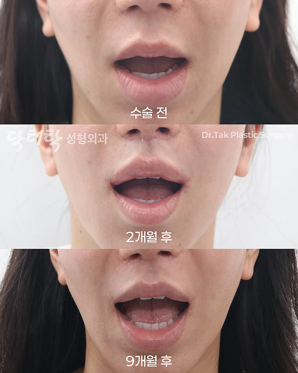 [แก้ไขใบหน้าส่วนกลาง_ก่อน-หลัง] ศัลยกรรมยกริมฝีปากบน (Lip Lift) + ยกริมฝีปากด้านข้าง (Lateral Lip Lift) + ยกมุมปาก (Corner Lip Lift) + สลายฟิลเลอร์ริมฝีปากล่าง - แก้ไขริมฝีปาก, แก้ไขส่วนกลางใบหน้า (ร่องริมฝีปากบน) เคสก่อน-หลัง 2