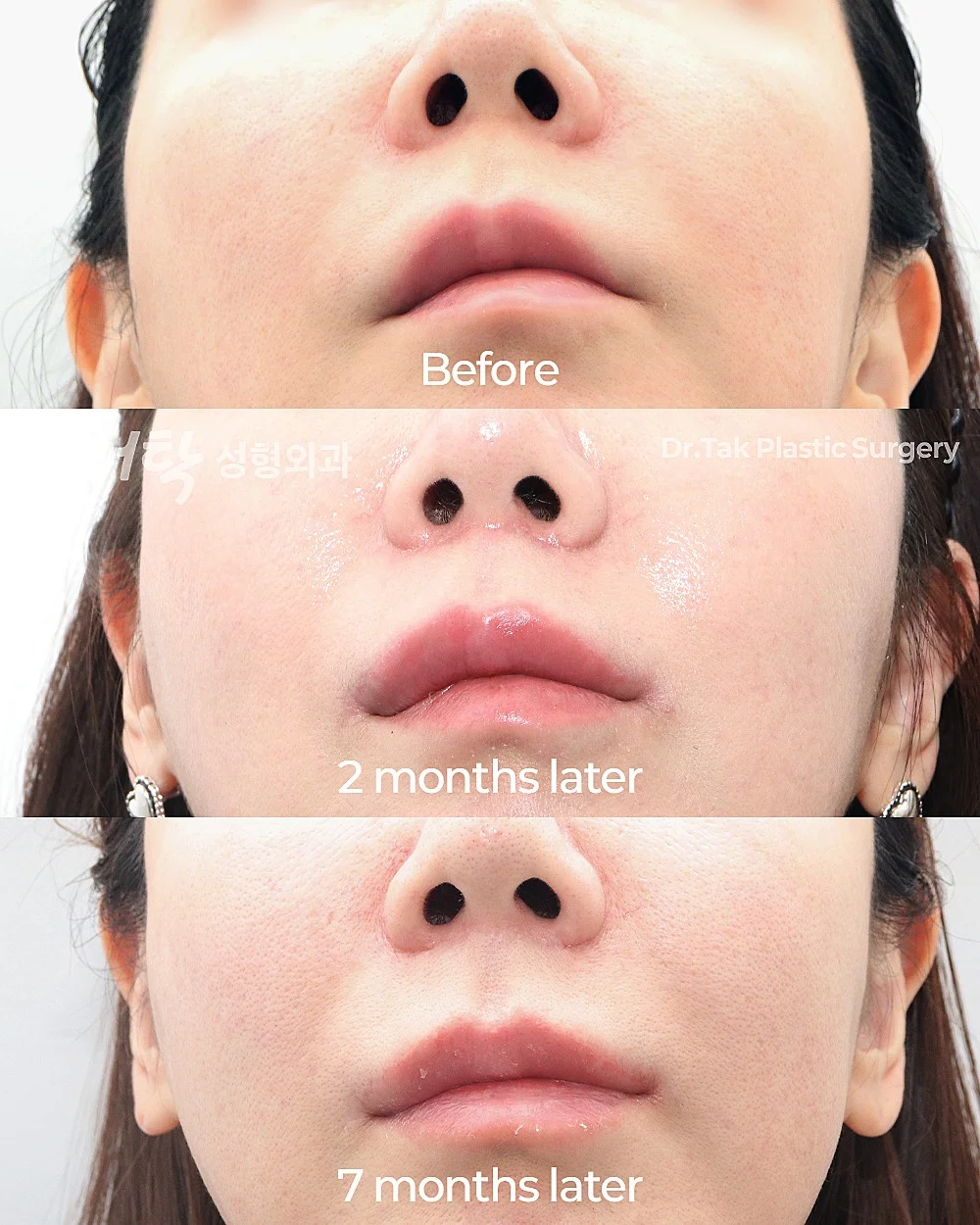 [ศัลยกรรมปรับรูปปาก] ศัลยกรรมยกริมฝีปากบน (Lip Lift) + ยกริมฝีปากด้านข้าง (Lateral Lip Lift) + ยกมุมปาก (Corner Lip Lift) - แก้ไขริมฝีปาก, แก้ไขส่วนกลางใบหน้า (ร่องริมฝีปากบน) เคสก่อน-หลัง 2