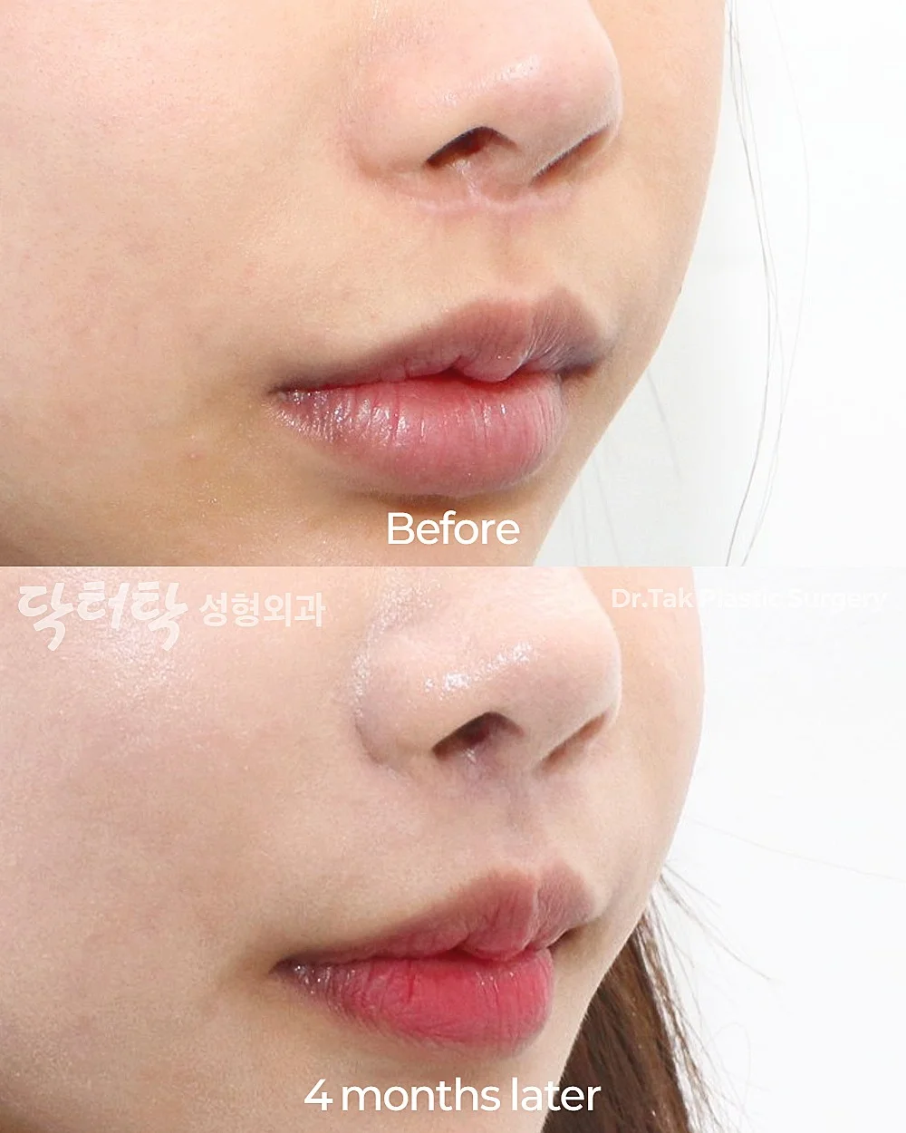 [แก้แผลเป็นจากการยกริมฝีปากบน_ก่อน-หลัง] แก้ไข Lip Lift - แก้ไขส่วนกลางใบหน้า (ร่องริมฝีปากบน), แก้ไขแผลเป็น เคสก่อน-หลัง 3
