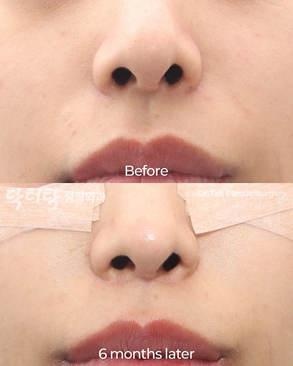 [ลดร่องริมฝีปากบน ก่อน-หลัง] ศัลยกรรมยกริมฝีปากบน (Lip Lift) - แก้ไขส่วนกลางใบหน้า (ร่องริมฝีปากบน) เคสก่อน-หลัง 2